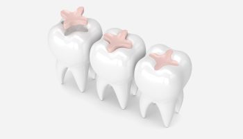 5 Types of Dental Fillings: Pros and Cons